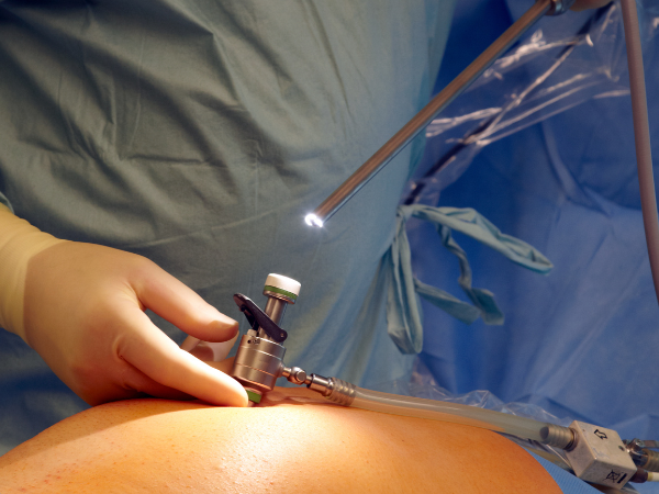 Single Incision Laparoscopic Surgery